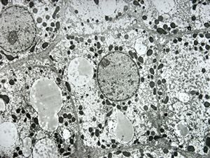 F,1y. | glycogenosis type II. (glycogen dissolved due to UA blockstaining)